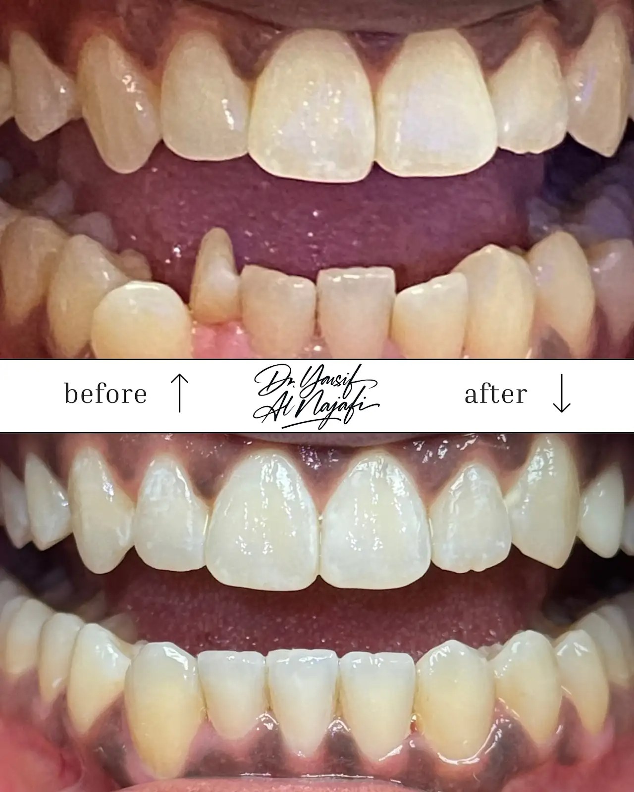 Invisalign — bite correction