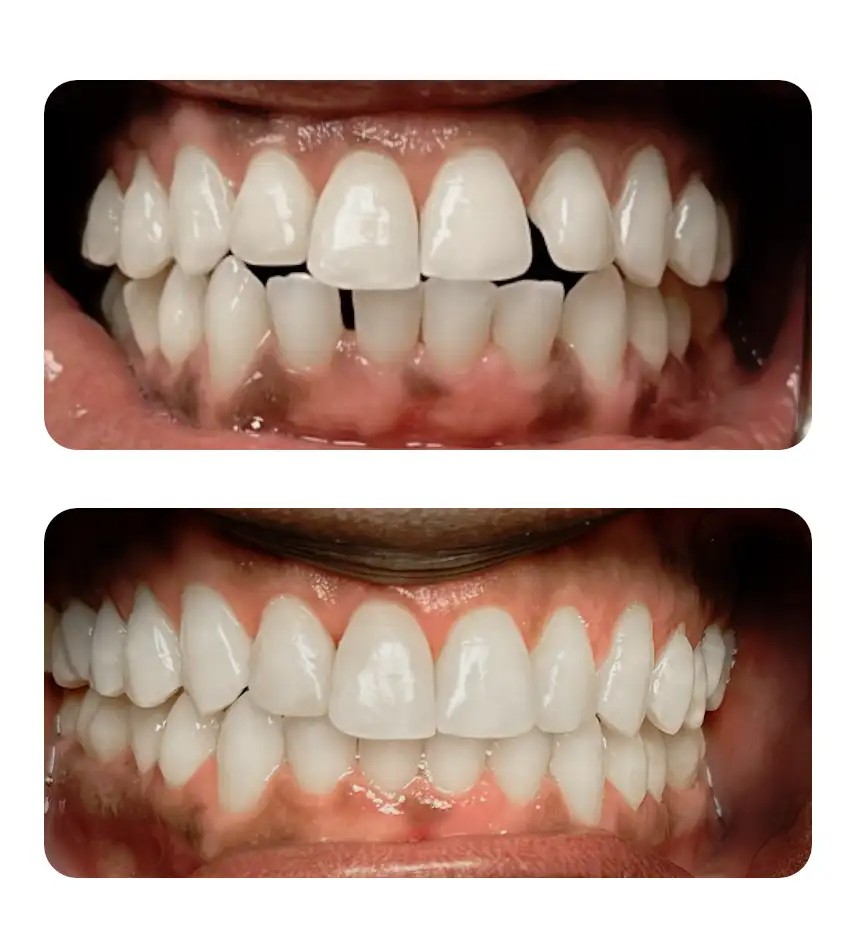 Invisalign — crowding