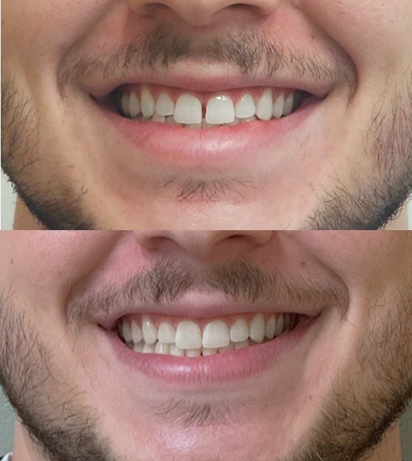 Invisalign — spacing