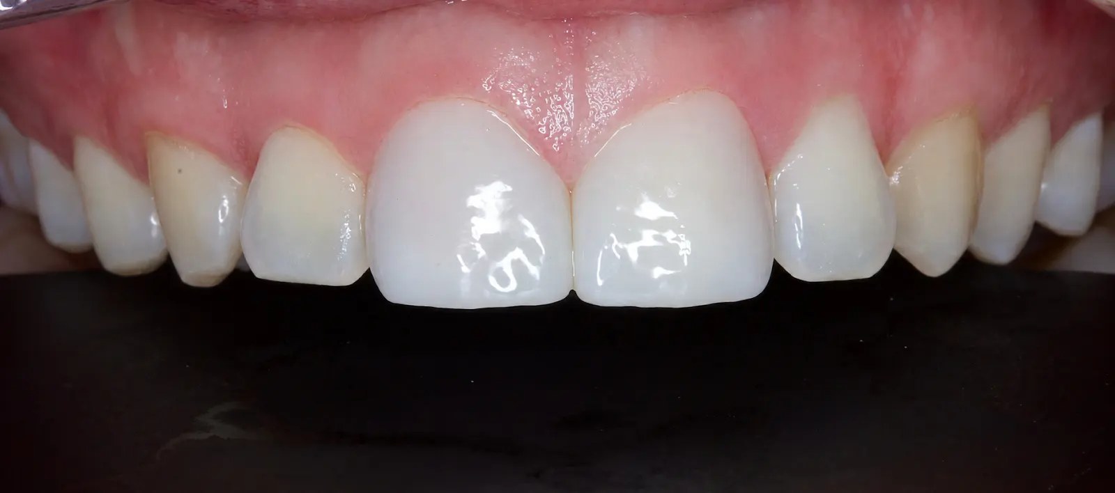 Composite bonding — chipped front tooth, after