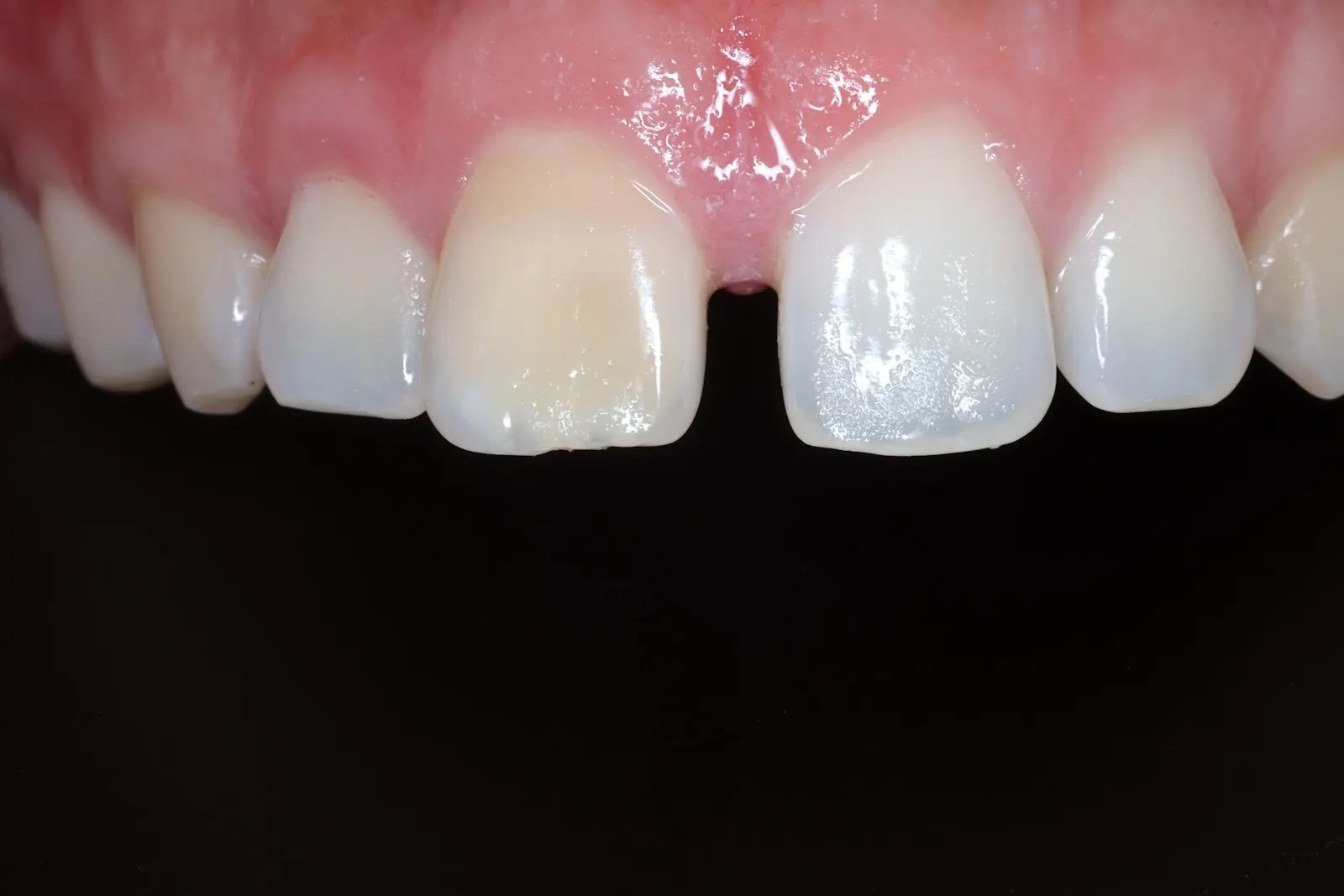 Composite bonding — chipped front tooth, before